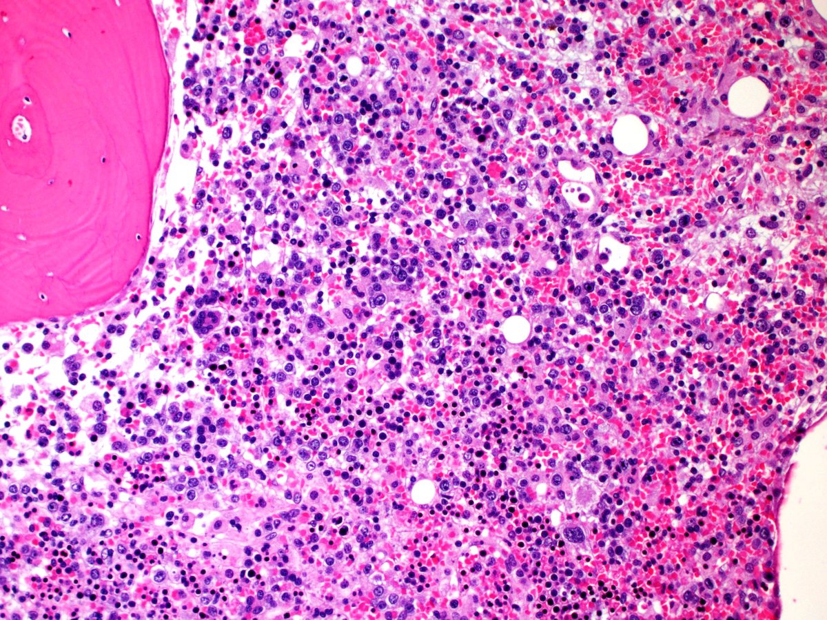 Core biopsy section adjacent to necrotic area showing small clusters of atypical large lymphoid cells (H&E, 200x)